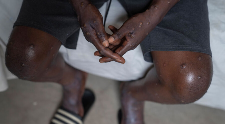 Mpox ist eine seltene Viruserkrankung. Symbolfoto: picture alliance / ASSOCIATED PRESS | Moses Sawasawa